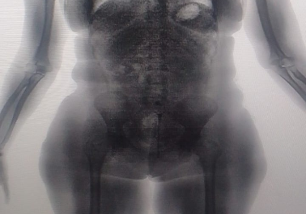 Mulher é flagrada pelo BodyScan tentando entrar com drogas nas partes íntimas em presídio na Bahia