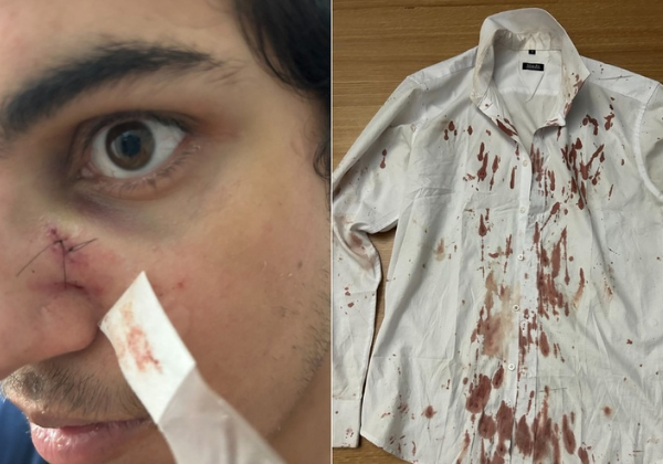 Turista leva pontos no nariz ao ser assaltado no Festival Virada Salvador