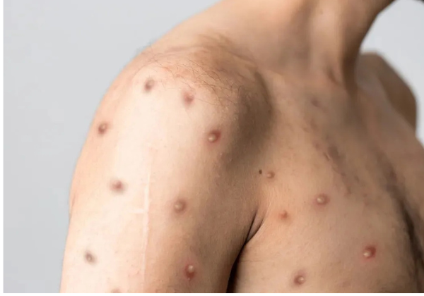 Sesab confirma dois casos de Mpox em Salvador e Vitória da Conquista