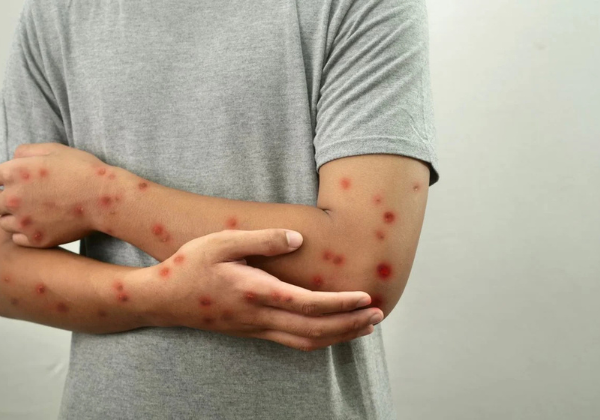 Bahia registra sete notificações de suspeita de Mpox; cinco foram descartadas