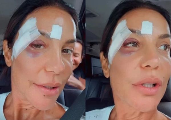 Cirurgia de Ivete Sangalo durou quase seis horas e corrigiu fratura na mandíbula 