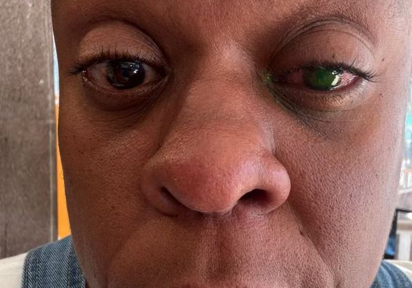 Cacau Protásio sofre perda temporária ocular grave após uso de pomada capilar 