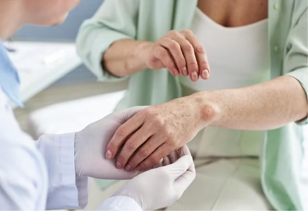 Clínica abre vagas para estudo que pode reduzir tempo de tratamento da hanseníase em Salvador