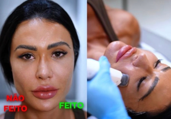 Gracyanne Barbosa aposta em beleza natural e abandona preenchimentos faciais