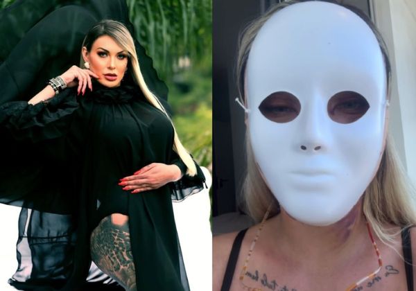 Andressa Urach mostra novo rosto após 50ª cirurgia plástica: ‘Vou ter 23 anos novamente’ 