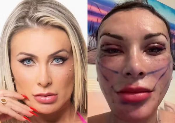 Andressa Urach exibe recuperação após cirurgia facial de rejuvenescimento: ‘Quero aparência mais jovem’ 