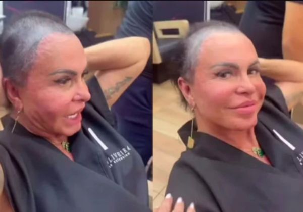Gretchen aparece sem prótese capilar e desabafa sobre tratamento contra alopecia
