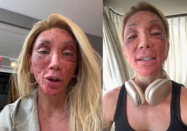 Maya Massafera mostra rosto inchado após peeling e tranquiliza seguidores