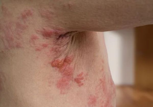 Canetas emagrecedoras podem aumentar risco de herpes, diz estudo