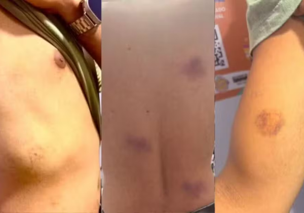 MP denuncia 7 PMs por agredir foliões no Carnaval de Salvador; vítima passou por cirurgia na mandíbula
